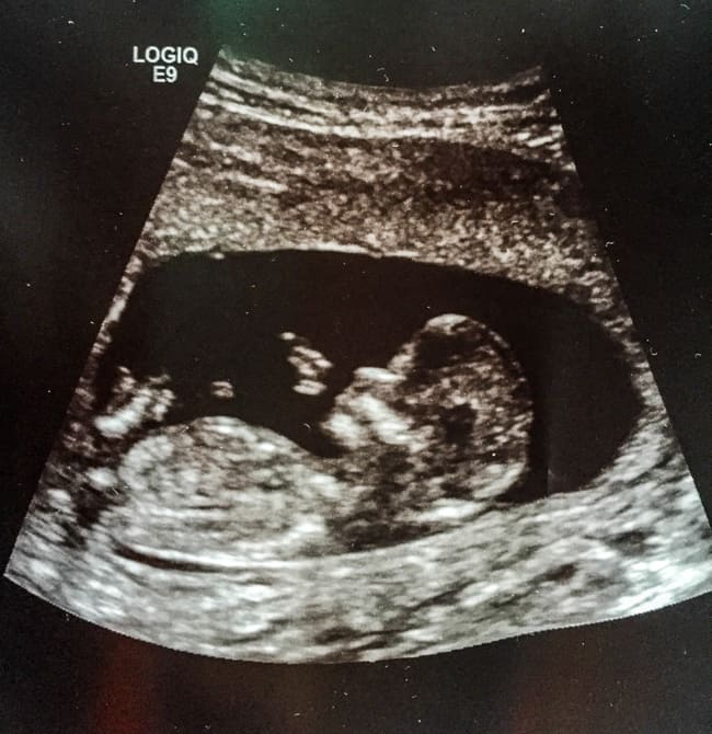 Ultrasound of baby at 12 weeks.